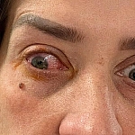 Жительница Англии временно ослепла из-за ношения контактных линз без перерыва