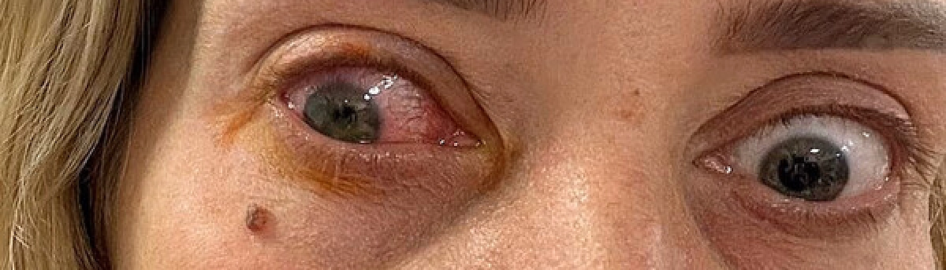 Жительница Англии временно ослепла из-за ношения контактных линз без перерыва